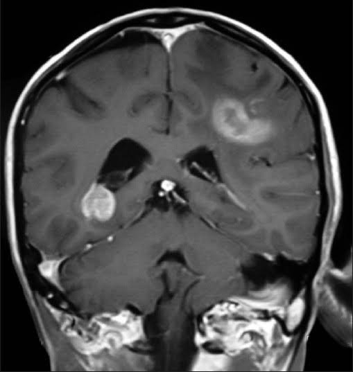 Glioma VERIFIED