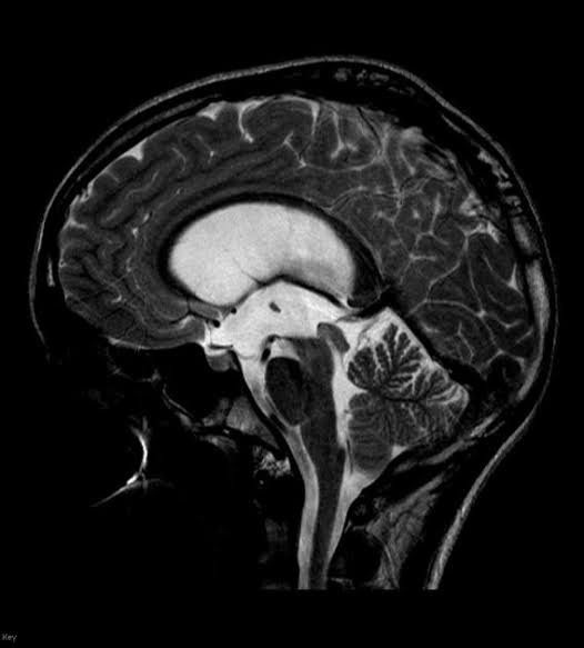Glioma MID