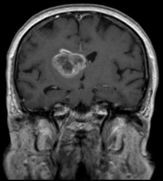 Glioma LOW