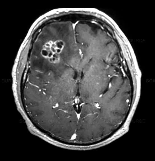 Glioma HIGH