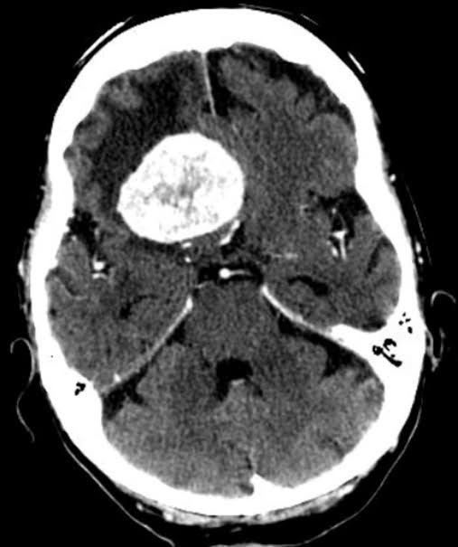 Meningioma VERIFIED