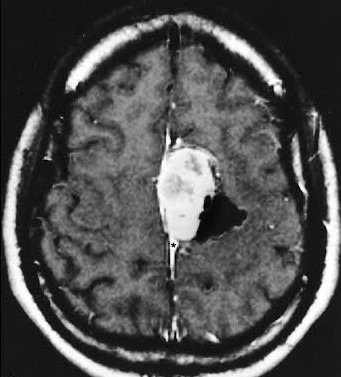 Meningioma MID