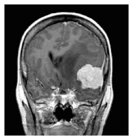 Meningioma LOW