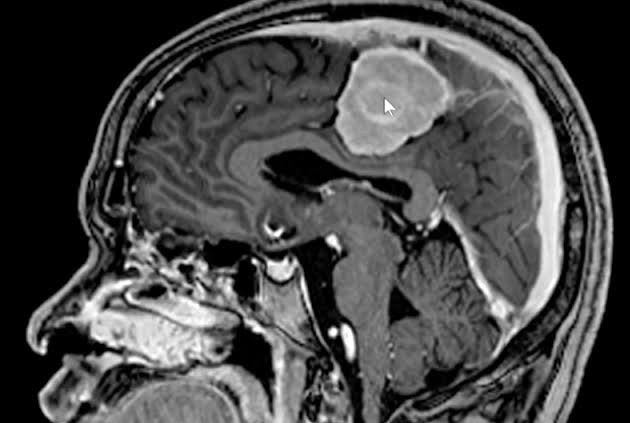 Meningioma HIGH