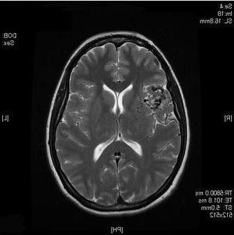 No Tumour MID