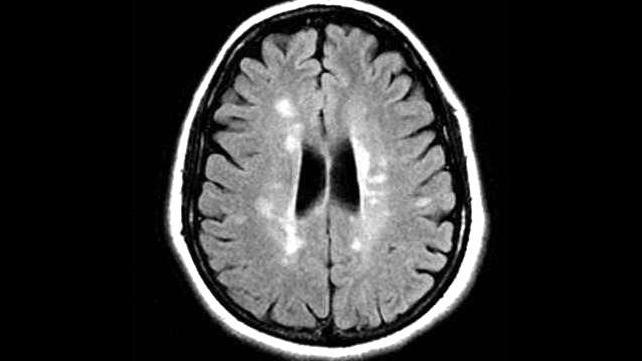 No Tumour LOW