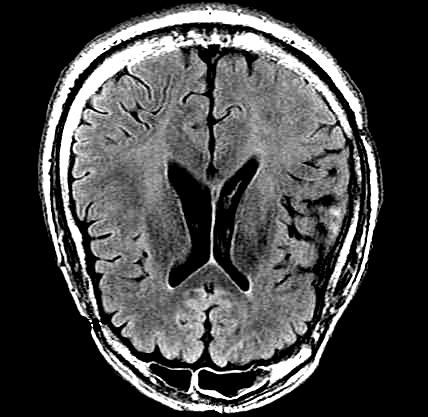 No Tumour HIGH