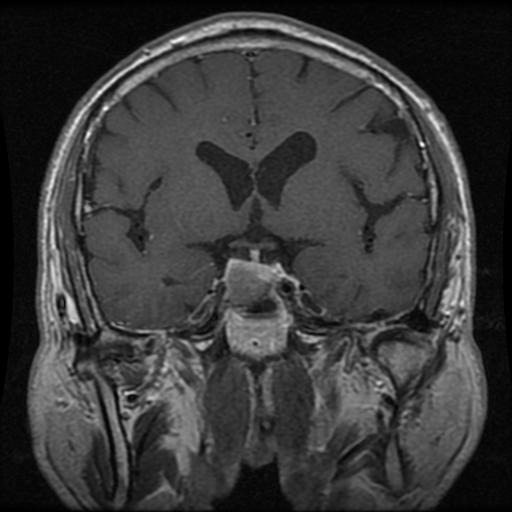 Pituitary VERIFIED
