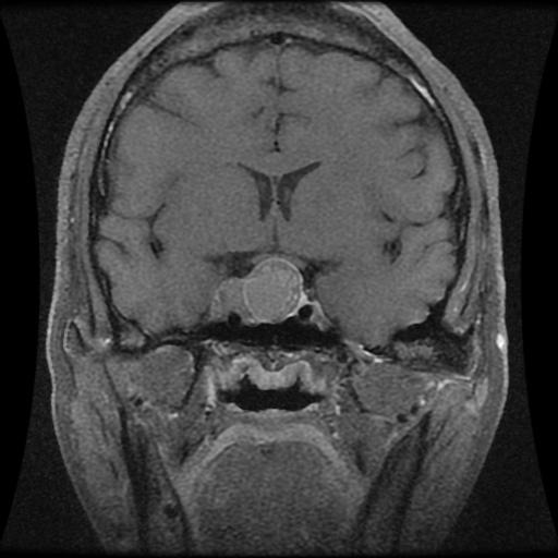 Pituitary MID