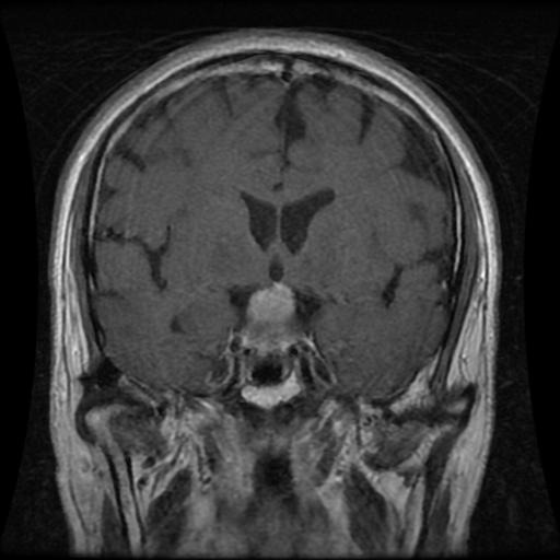 Pituitary HIGH